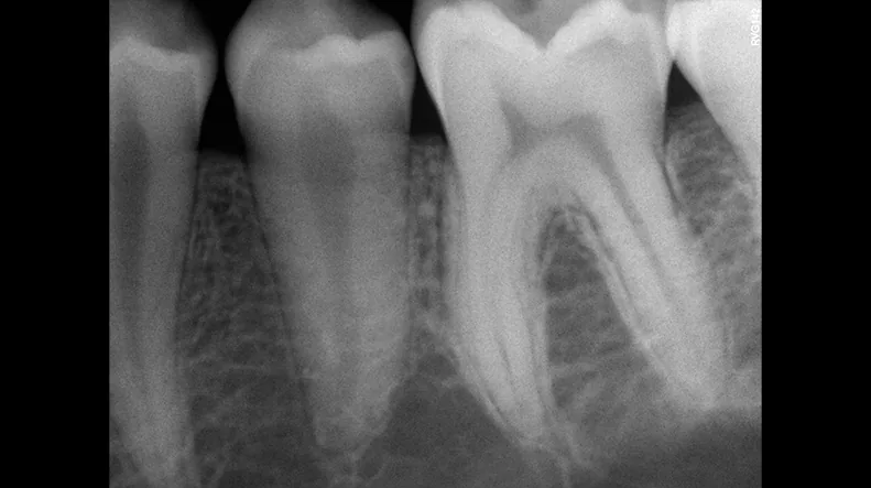 Radiografía periapical adquirida con el sensor RVG 142.