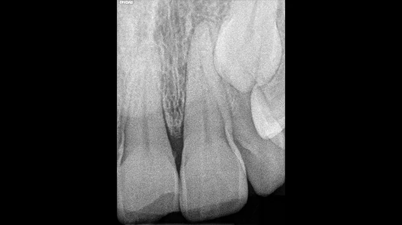 Radiografía periapical de la zona anterior adquirida con el RVG 142.