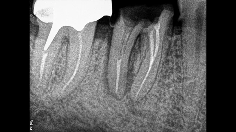 Radiografía periapical de endodoncia adquirida con el RVG 142.