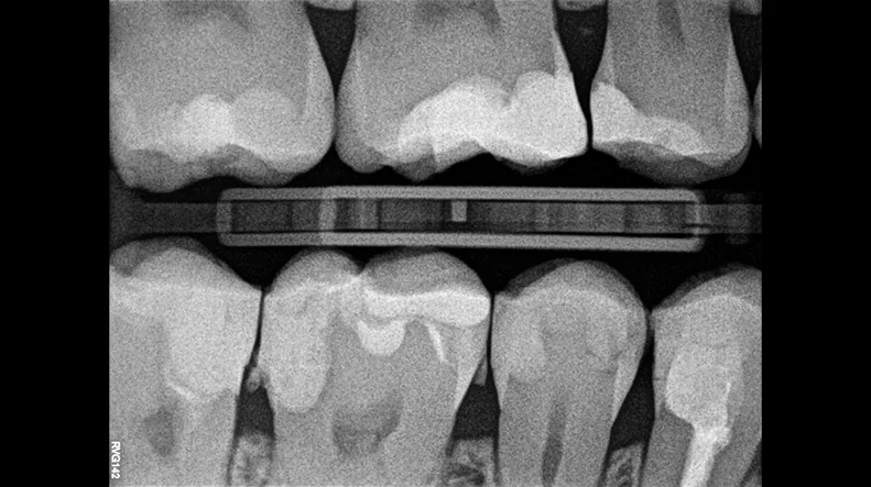 Radiografía de aleta de mordida adquirida con el sensor RVG 142.