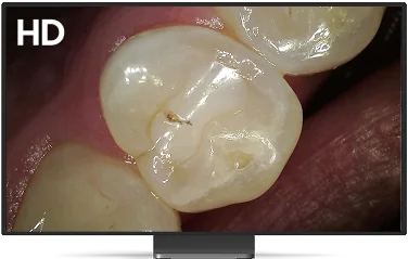 Imagen intraoral en alta definición de un molar, vista en monitor.