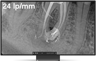 Radiografía periapical de endodoncia adquirida con el RVG 6200, con la leyenda 24 pl/mm.