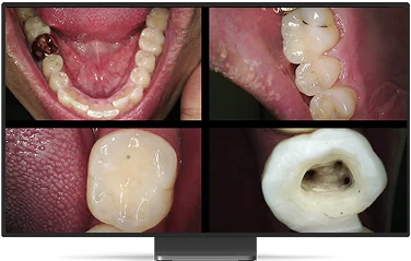 Cuatro imágenes intraorales de distinta escala: arcada, detalle de molar y cámara pulpar.