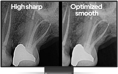 La misma radiografía con dos filtros CS Adapt: alta nitidez y suavizado optimizado.